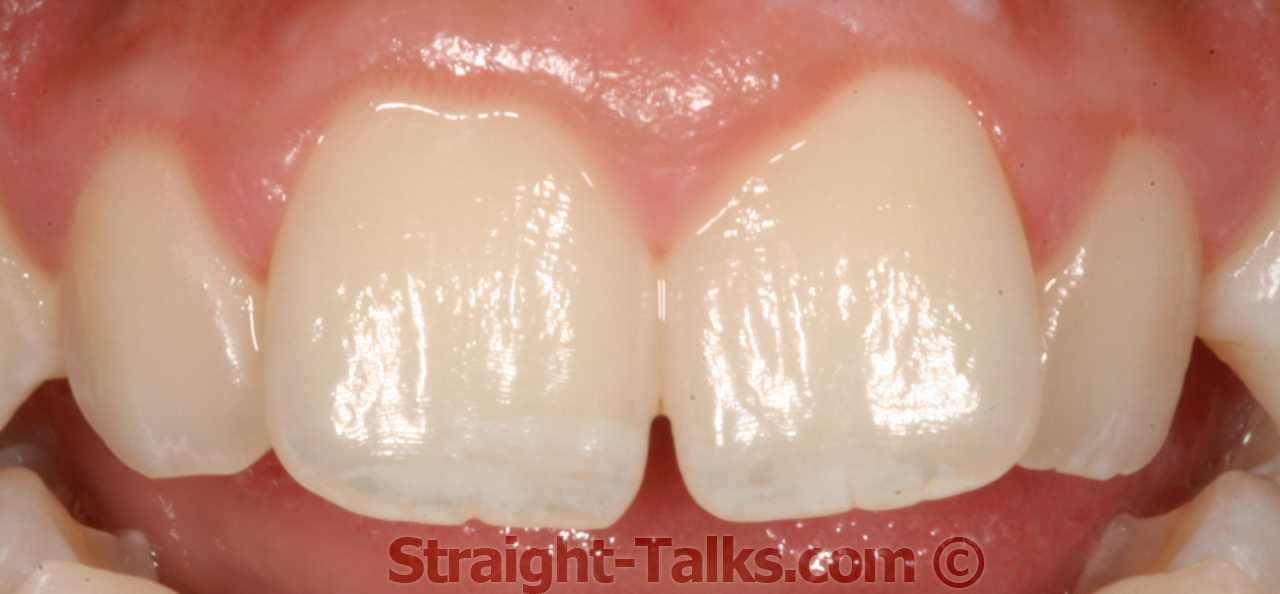Before Inman Aligner treatment